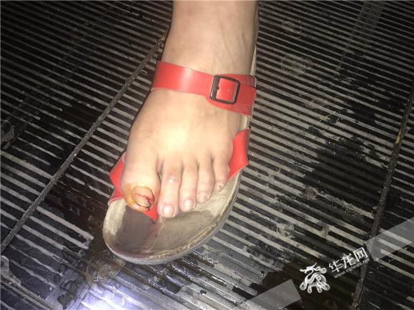 女孩受伤的大脚趾.沙坪坝警方供图 华龙网发