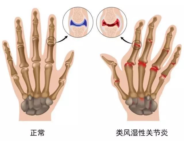 类风湿型关节炎:南方人多发,多发于身体手指,脚趾等小关节处