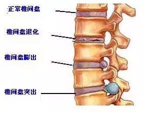 颈腰椎衰老分5个阶段你现在到了哪一步快自测