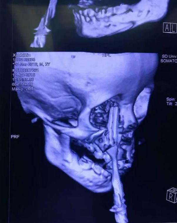 齐鲁医院成功救治面部餐叉穿刺伤患儿!请收下这份带娃