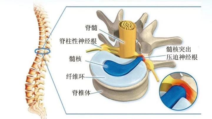 关于腰椎间盘突出症,你需要了解这些