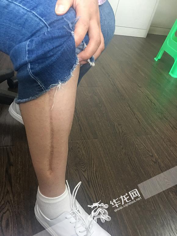 衡永红腿上的伤痕.市急救中心供图 华龙网发