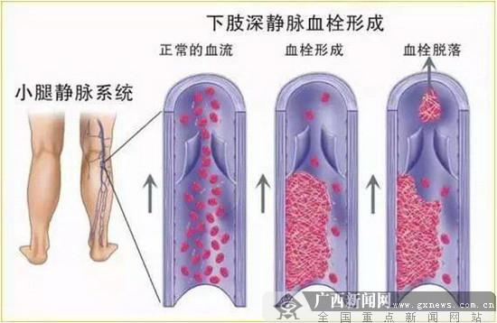 南溪山醫(yī)院成為廣西首批靜脈血栓防治聯(lián)盟成員單位