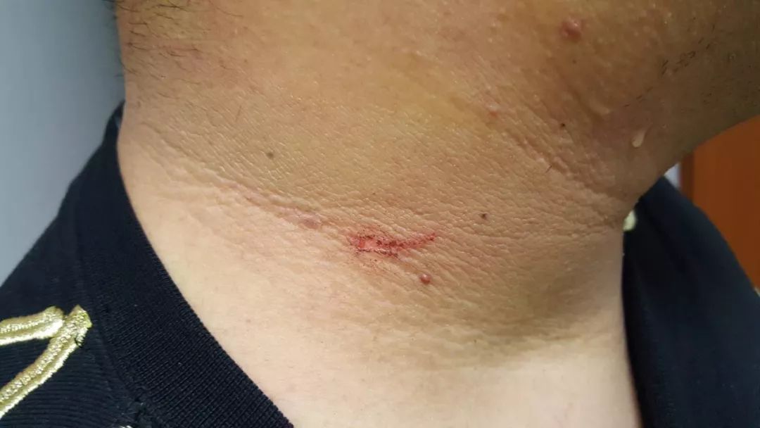 (图为民警脖子上的抓伤)