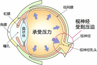 青光眼窃取光明的小偷