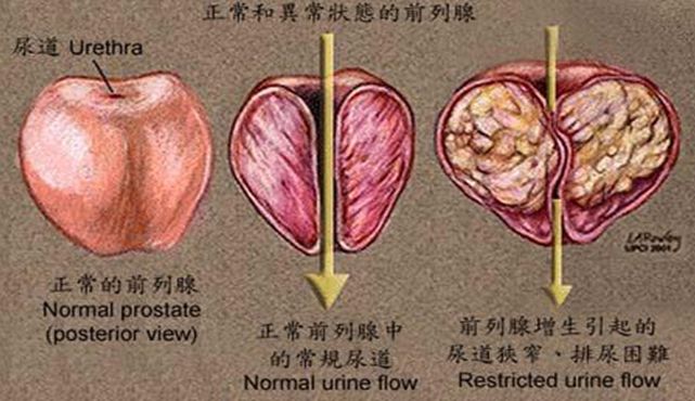 不良习惯会诱发前列腺增生前列腺增生发病率这么高,是因为它就像人老