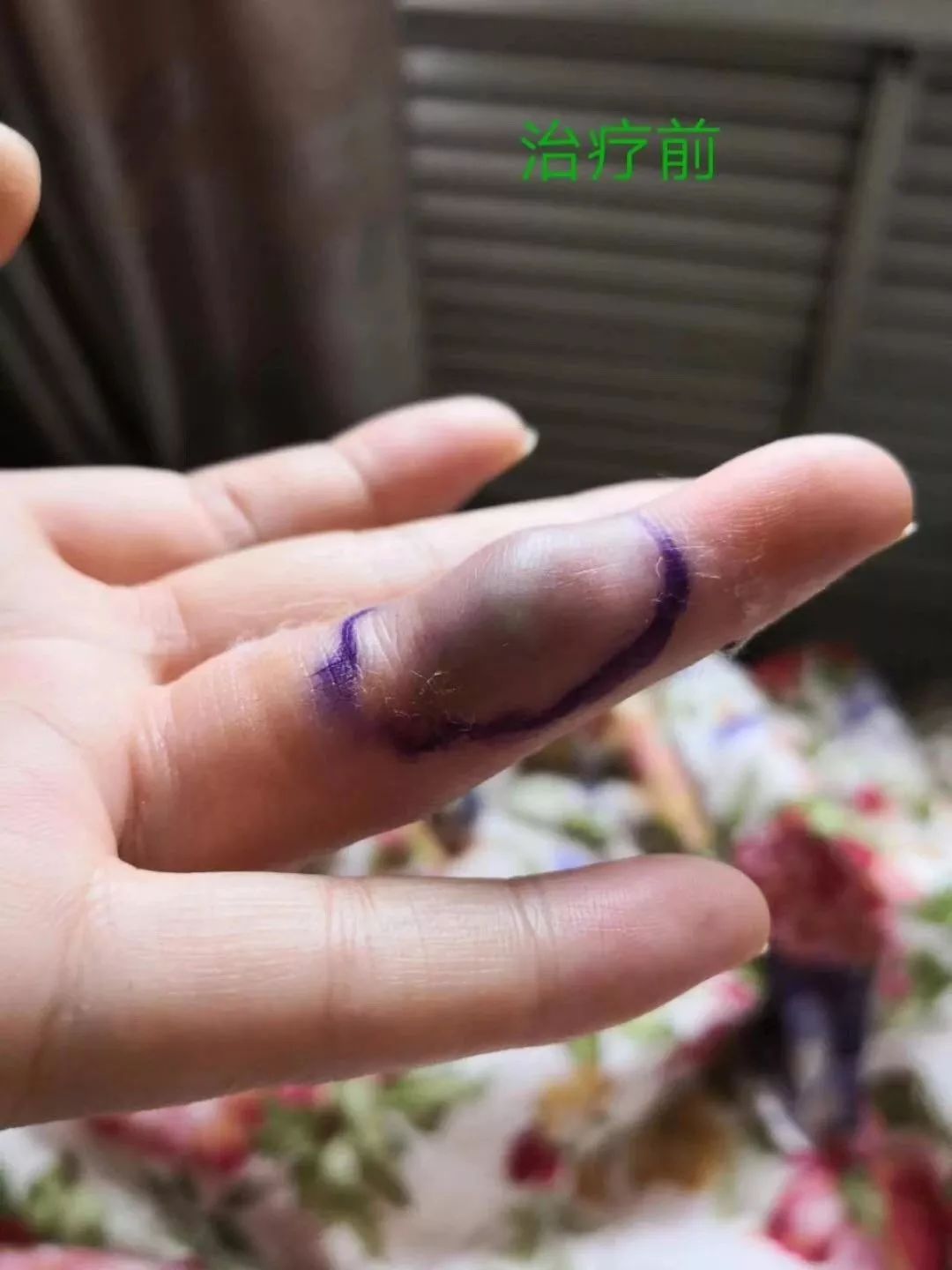 妈妈拎了20斤菜手指居然被勒出血管瘤医生说这几类人要注意